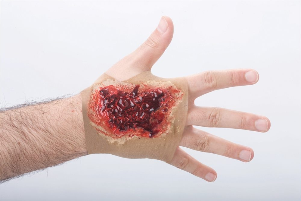 Picture of Acid Burn Hand Sleeve